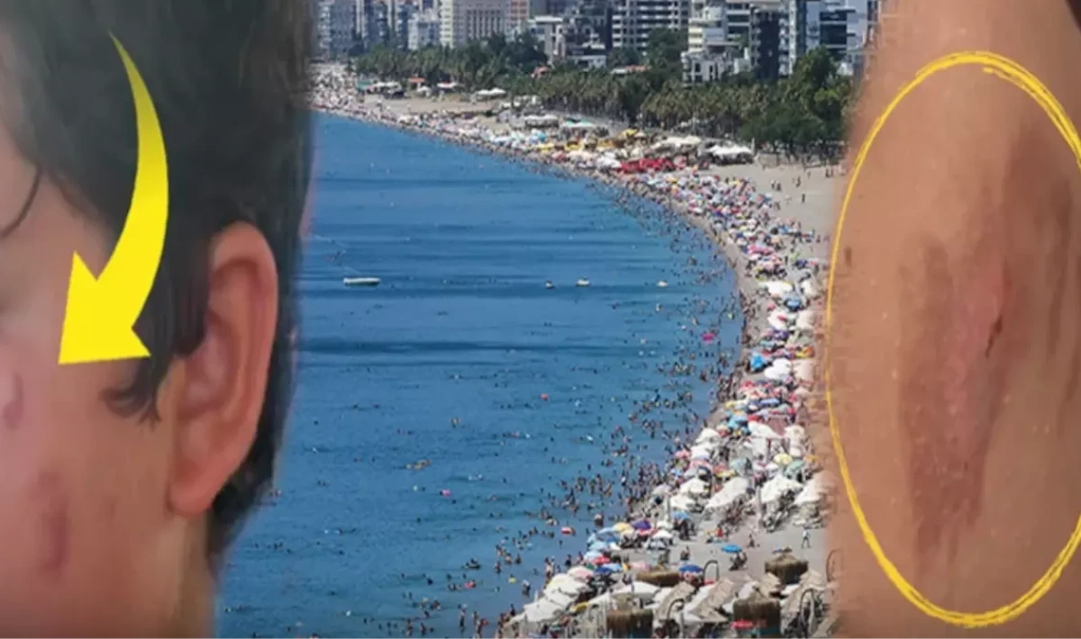 Antalya Sahillerinde Alarm! Denize Giren Yanık ve Kaşıntıyla Çıkıyor